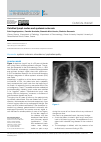 Научная статья на тему 'Calcified lymph nodes and systemic sclerosis'