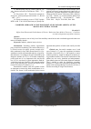 Научная статья на тему 'Combined approach to the treatment of secondary adentia of the maxillary central incisor'