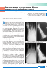 Научная статья на тему 'Хирургическое лечение стопы Шарко, осложненной гнойной инфекцией'