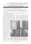 Научная статья на тему 'Имплантация безэлектродного электрокардиостимулятора после удаления Инфицир ованных электродов'