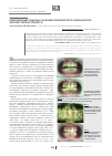 Научная статья на тему 'Комплексный подход к лечению хронического пародонтита легкой степени тяжести'