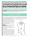 Научная статья на тему 'Лапароскопическая колонопексия: техника выполнения'