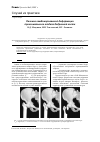 Научная статья на тему 'Лечение комбинированной деформации проксимального отдела бедренной кости'