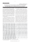 Научная статья на тему 'Пароксизмальные желудочковые тахикардии при проведении чреспищеводного электрофизиологического исследования'