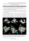 Научная статья на тему 'Первый в России опыт ультразвукового картирования для аблации фибрилляции предсердий'