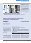Научная статья на тему 'Применение эндоваскулярной суперселективной эмболизации в лечении почечной артерио-венозной фистулы'