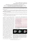 Научная статья на тему 'ПРИМЕНЕНИЕ СИСТЕМЫ НЕИНВАЗИВНОГО ПОВЕРХНОСТНОГО ЭЛЕКТРОКАРДИОГРАФИЧЕСКОГО КАРТИРОВАНИЯ ПРИ ЛЕЧЕНИИ ПАЦИЕНТА С ЭКТОПИЧЕСКОЙ ПРЕДСЕРДНОЙ ТАХИКАРДИЕЙ'