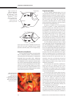 Научная статья на тему 'Symmetric volume-reduction plasty of the enlarged left atrium: 15-years clinical experience'