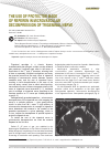 Научная статья на тему 'The use of protector made of Reperen in microvascular decompression of trigeminal nerve'