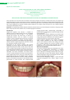 Научная статья на тему 'Usage of CAD/CAM ti̇-base lithium disilicate implant abutments in esthetic region'