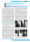 Научная статья на тему 'Жесткая инструментальная фиксация позвоночника в хирургическом лечении туберкулезного спондилита и хронического гематогенного остеомиелита позвоночника'
